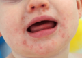 Cegah HFMD