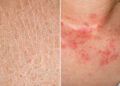 Kulit kering atau eczema