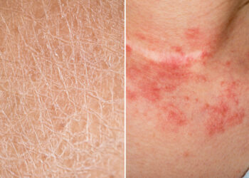 Kulit kering atau eczema