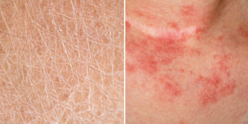 Kulit kering atau eczema