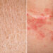 Kulit kering atau eczema