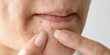 Skin Breakout Waktu Period? Ini Hidden Message dari Kitaran Haid! 