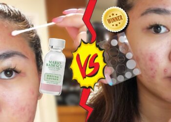 Baru Tahu! Ini Dia Perbedaan Dua Produk Jerawat Yang  Lagi Viral