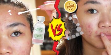 Baru Tahu! Ini Dia Perbedaan Dua Produk Jerawat Yang  Lagi Viral