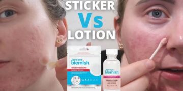 The Truth About Pimple Patches vs Acne Drying Lotion