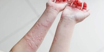 Gegata: Kulit Naik Gatal-Gatal? Ini Yang Anda Perlu Tahu!