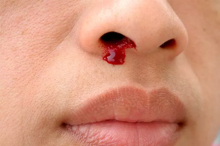 hidung berdarah