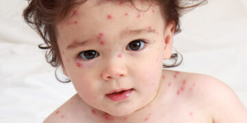 Bahaya Demam Campak Jika Tak Dirawat Awal