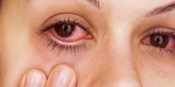 Sakit Mata Berjangkit? Ini Cara Kenal Pasti & Rawat Konjunktivitis