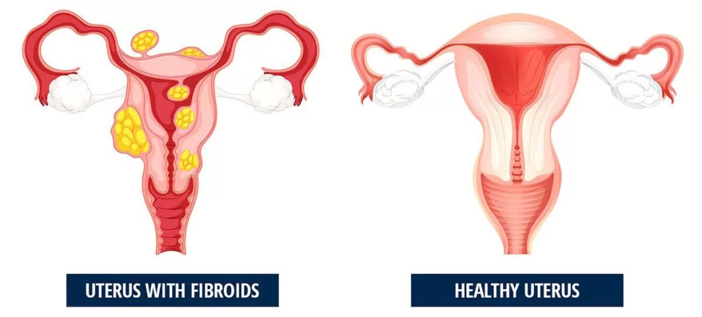 fibroid