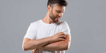 Kudis : Punca Sebenar & Cara Merawat Sebelum Melarat