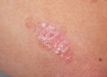 Apa Itu Psoriasis? Kenali Simptom, Punca & Rawatan