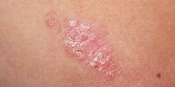 Apa Itu Psoriasis? Kenali Simptom, Punca & Rawatan