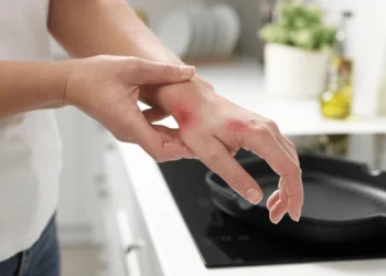 5 Langkah Mudah Merawat Luka Melecur di Rumah