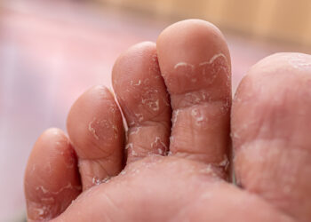 Kutu Air: Ketahui Punca, Simptom & Tips Rawatan Berkesan