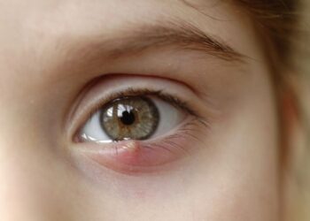 Apa Itu Ketumbit dan Cara Mudah Merawatnya di Rumah