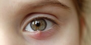 Apa Itu Ketumbit dan Cara Mudah Merawatnya di Rumah