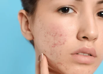 Acne Map: Petunjuk Masalah Hormon, Pemakanan & Gaya Hidup Anda