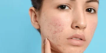 Acne Map: Petunjuk Masalah Hormon, Pemakanan & Gaya Hidup Anda