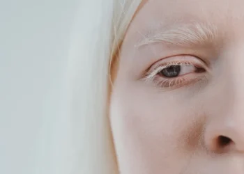 Albinisme: Bukan Penyakit Kulit, Tapi Memerlukan Penjagaan Rapi