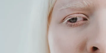 Albinisme: Bukan Penyakit Kulit, Tapi Memerlukan Penjagaan Rapi