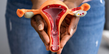 Bahaya Kanser Ovari – Kenali Risiko, Rawatan & Cara Mencegahnya