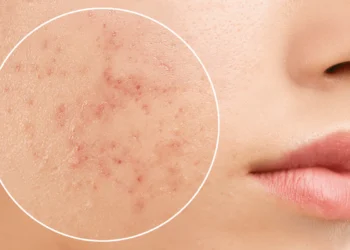 Cara Hilangkan Jerawat Secara Semulajadi Tanpa Ubat & Krim Mahal