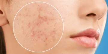 Cara Hilangkan Jerawat Secara Semulajadi Tanpa Ubat & Krim Mahal