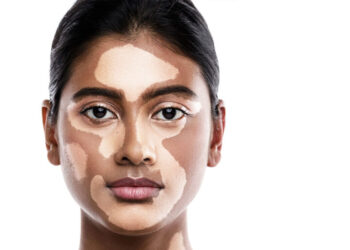 Vitiligo: Mitos vs Fakta — Ketahui Kebenaran Mengenainya