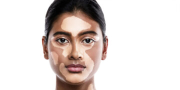 Vitiligo: Mitos vs Fakta — Ketahui Kebenaran Mengenainya