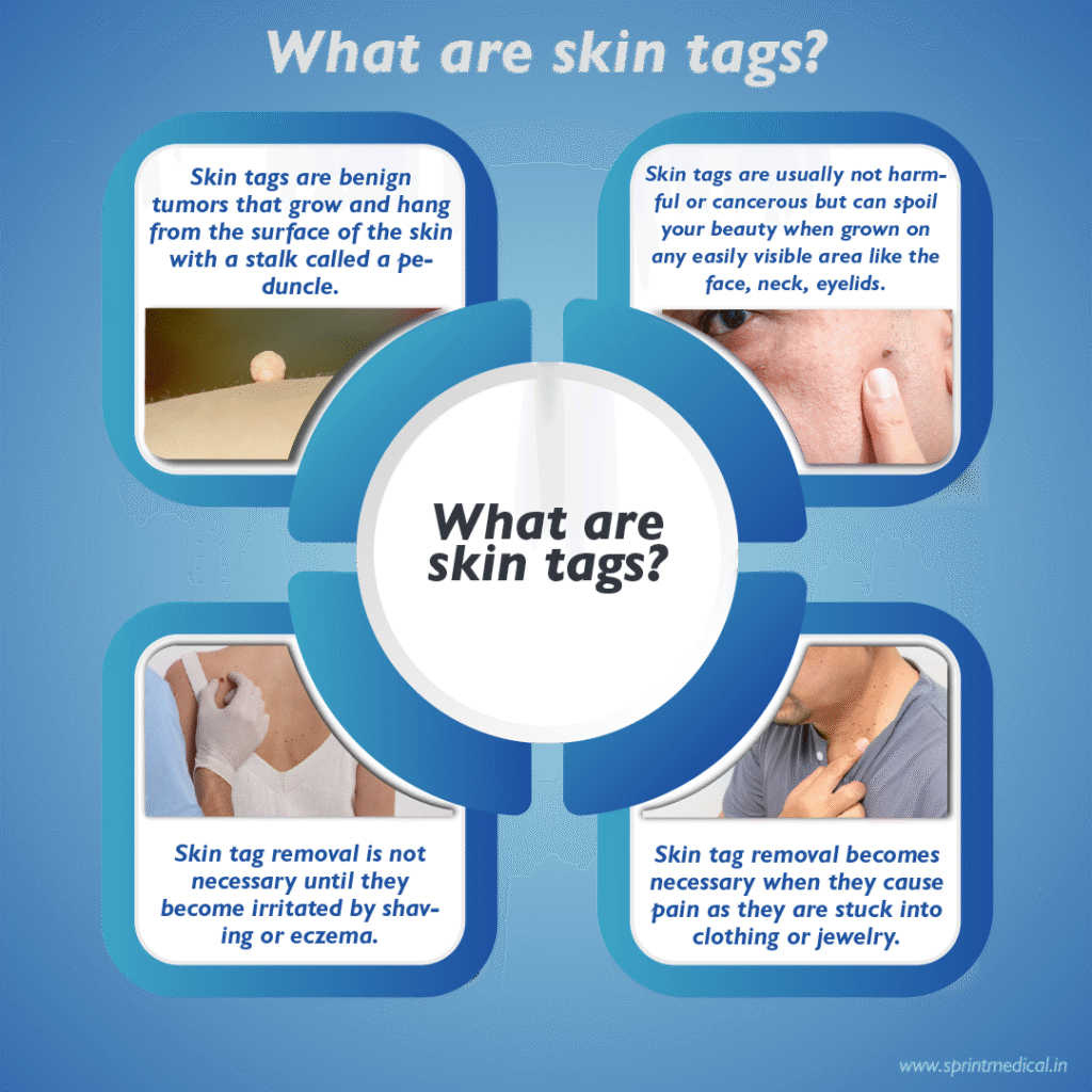 skin tag