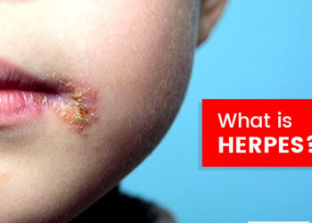 Apa Itu Herpes dan Adakah Ia Berbahaya?
