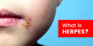 Apa Itu Herpes dan Adakah Ia Berbahaya?