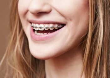 Kenapa Pakai Braces? Bukan Sekadar Untuk Kecantikan Gigi