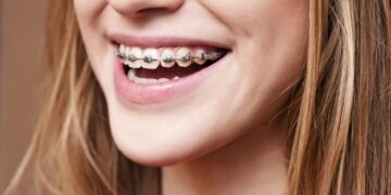 Kenapa Pakai Braces? Bukan Sekadar Untuk Kecantikan Gigi