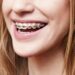 Kenapa Pakai Braces? Bukan Sekadar Untuk Kecantikan Gigi