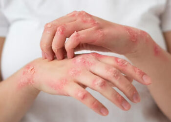 Simptom Herpes: Tanda Awal yang Tidak Boleh Dipandang Ringan