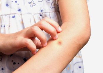 Kulit Gatal Tak Hilang-Hilang? Ketahui Puncanya Sekarang