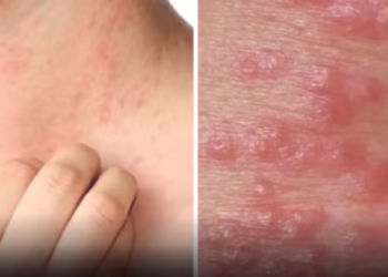 Kenali Kudis: Jenis, Simptom & Langkah Pencegahan