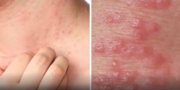 Kenali Kudis: Jenis, Simptom & Langkah Pencegahan