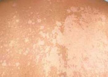 Panau: Punca, Simptom & Cara Hilangkan Tompok Putih di Kulit