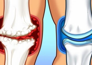 10 Makanan Semulajadi untuk Sakit Sendi yang Berkesan