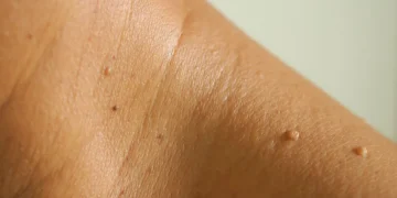 Kenapa Skin Tag Muncul? Ketahui Punca & Cara Mengatasinya