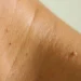 Kenapa Skin Tag Muncul? Ketahui Punca & Cara Mengatasinya