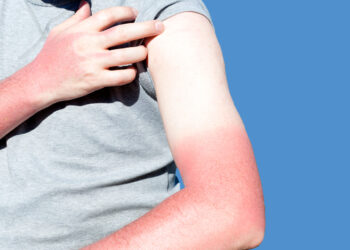 Kulit Menggelupas Akibat Sunburn? Ini Apa Anda Perlu Buat