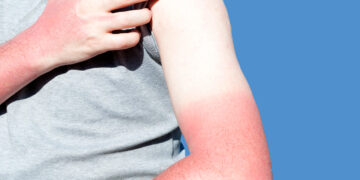 Kulit Menggelupas Akibat Sunburn? Ini Apa Anda Perlu Buat