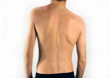 Apa Itu Scoliosis? Punca, Simptom & Cara Rawatannya