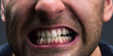 Bruxism: Tabiat Gesel Gigi Waktu Tidur Jejas Kesihatan Mulut