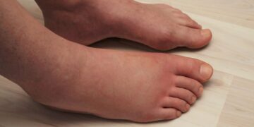 Bengkak Kaki? Ketahui Punca & Cara Menghilangkannya