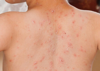 Jangkitan Campak Pada Kanak-Kanak & Dewasa: Simptom, Rawatan dan Vaksin